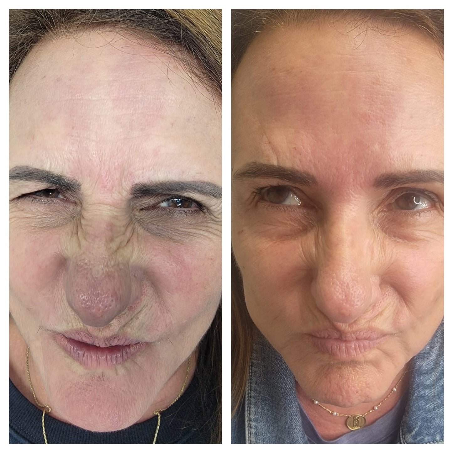 Cosmetic Botox.   BEFORE AND AFTER