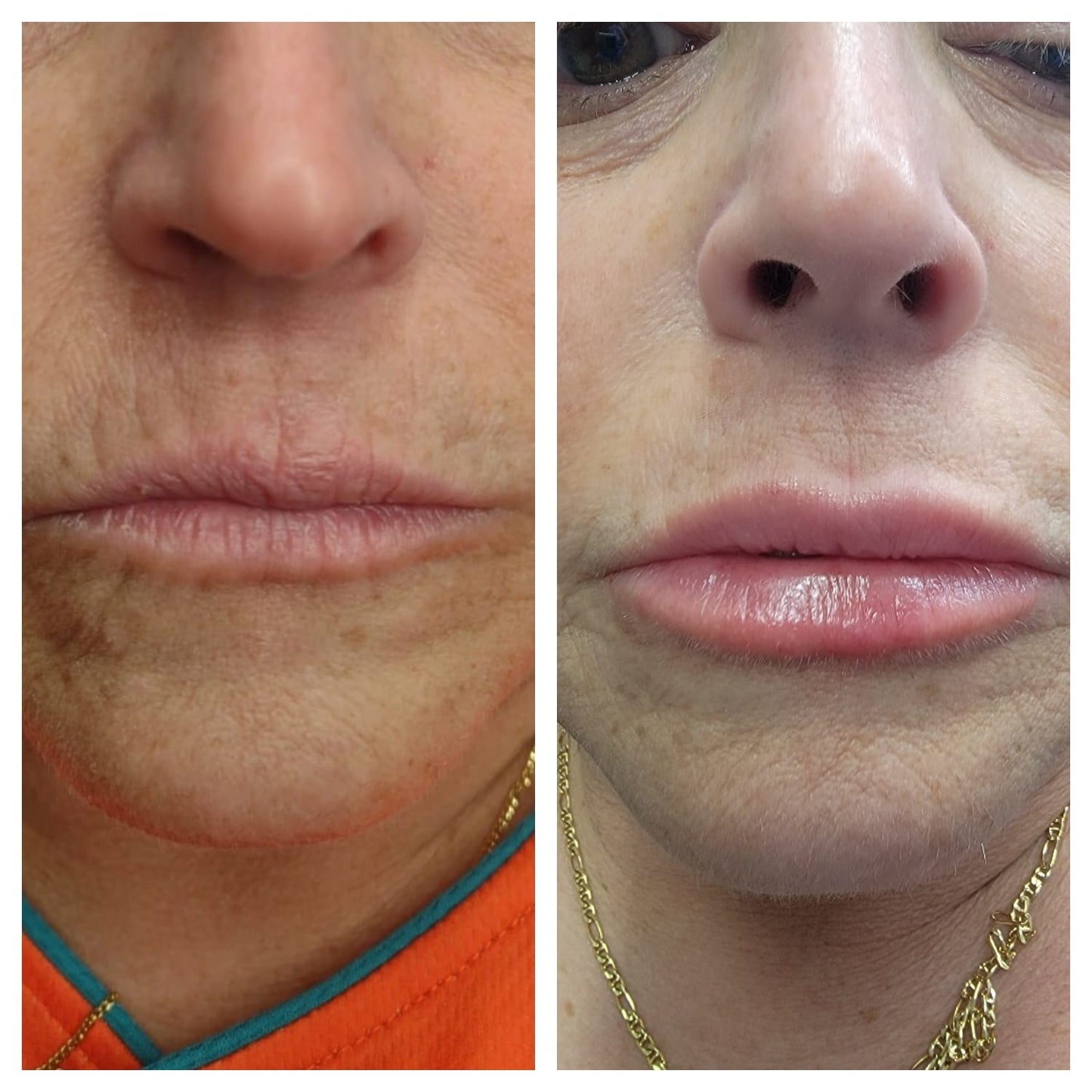 Lip fillers. BEFORE AND AFTER