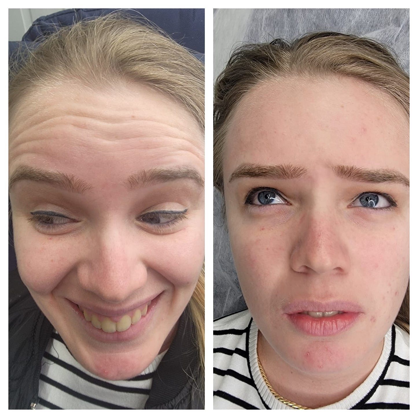 Cosmetic Botox.   BEFORE AND AFTER