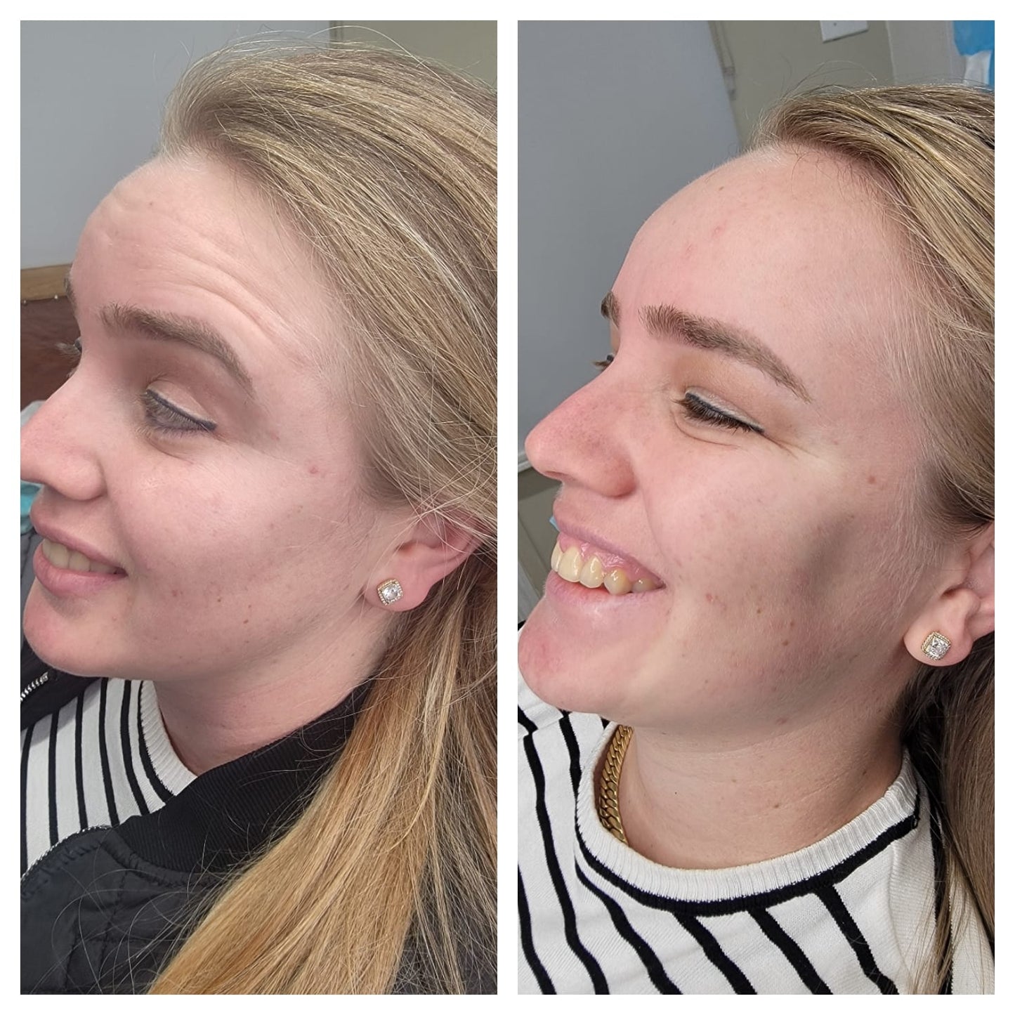 Cosmetic Botox.   BEFORE AND AFTER