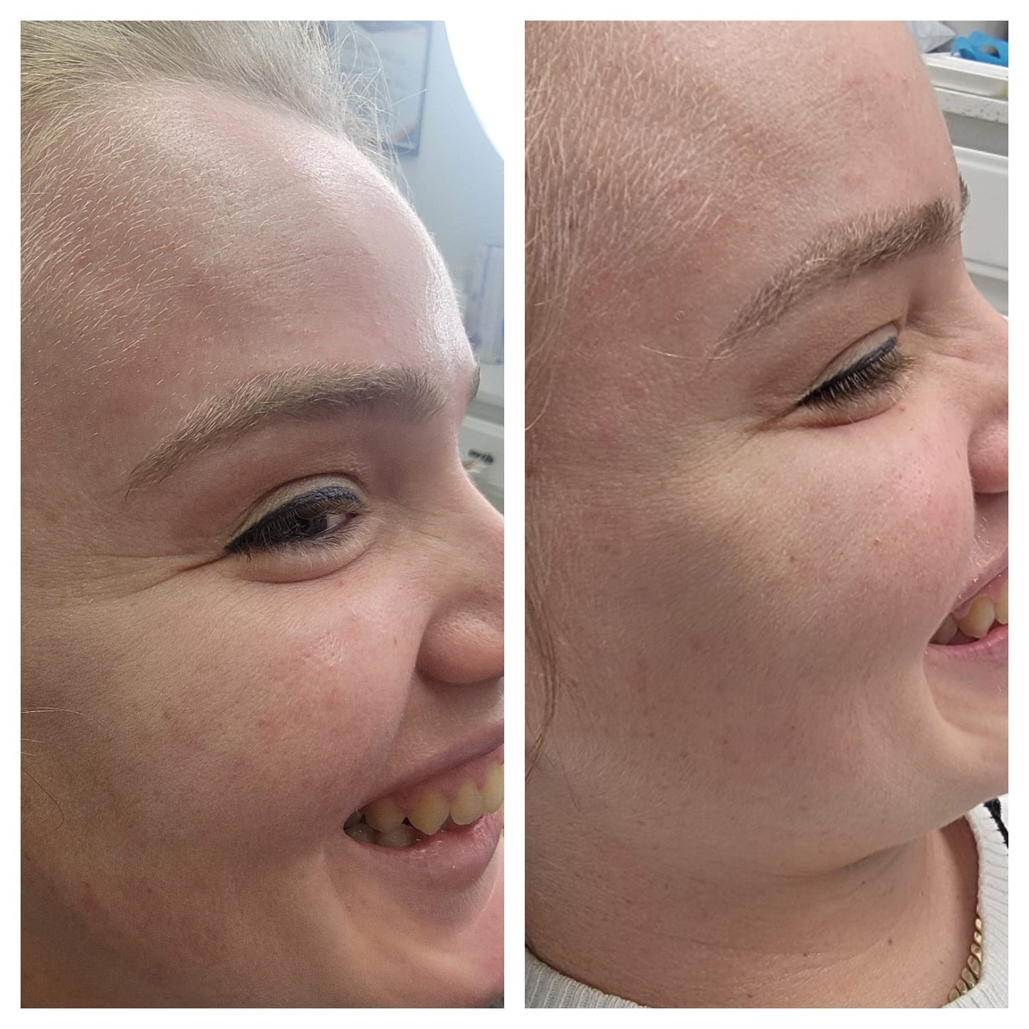 Cosmetic Botox.   BEFORE AND AFTER