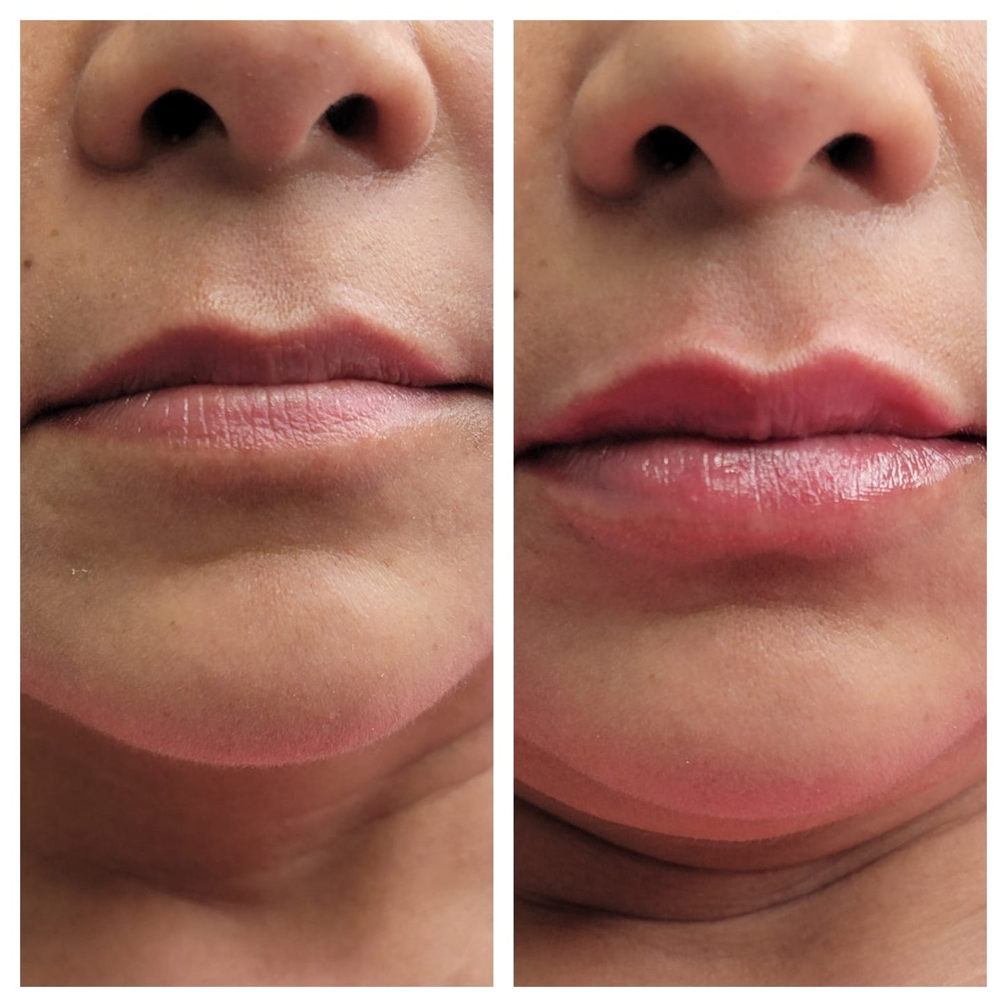 Lip fillers. BEFORE AND AFTER