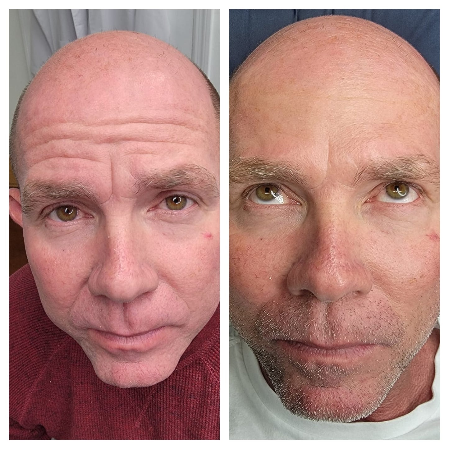 Cosmetic Botox.   BEFORE AND AFTER