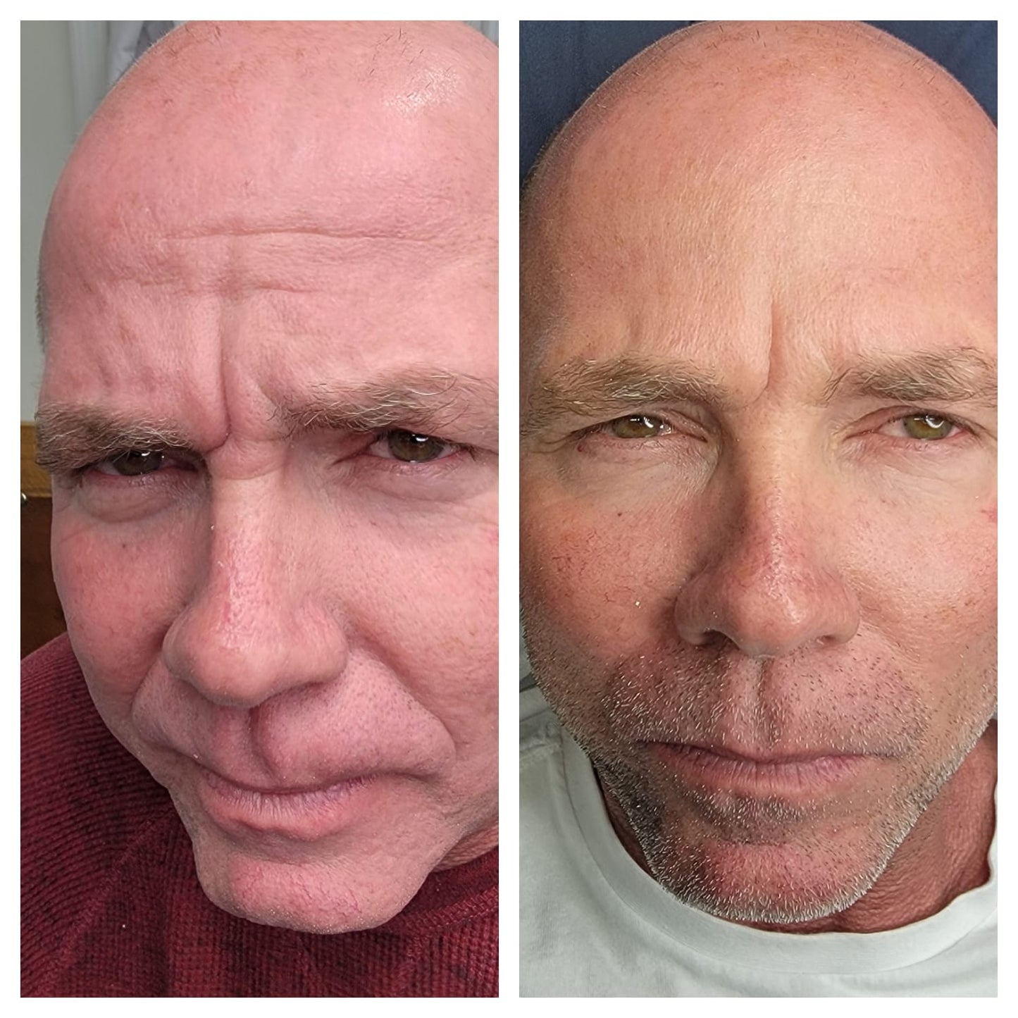 Cosmetic Botox.   BEFORE AND AFTER