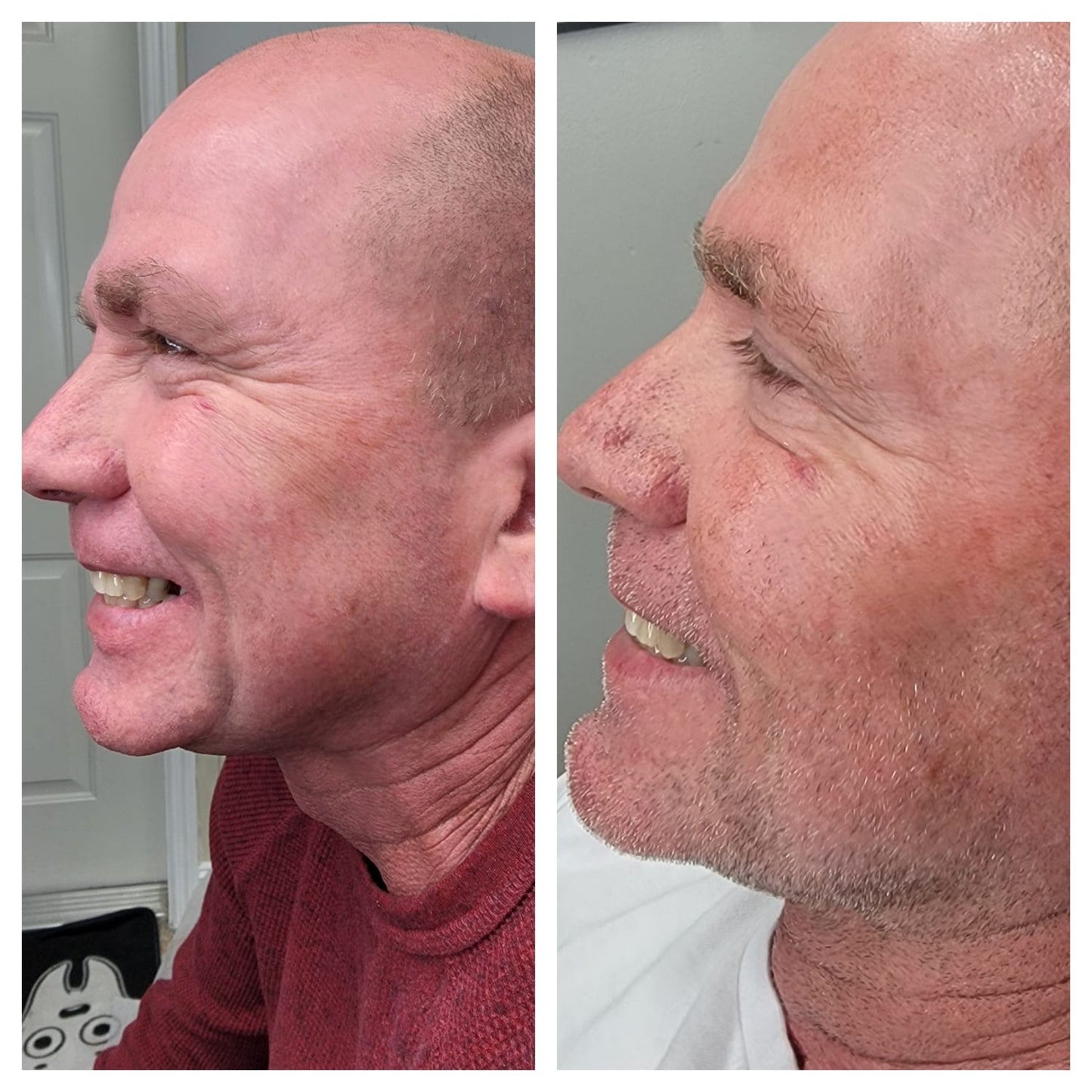 Cosmetic Botox.   BEFORE AND AFTER