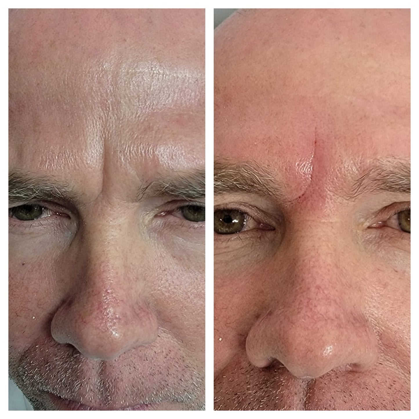 Cosmetic Botox.   BEFORE AND AFTER