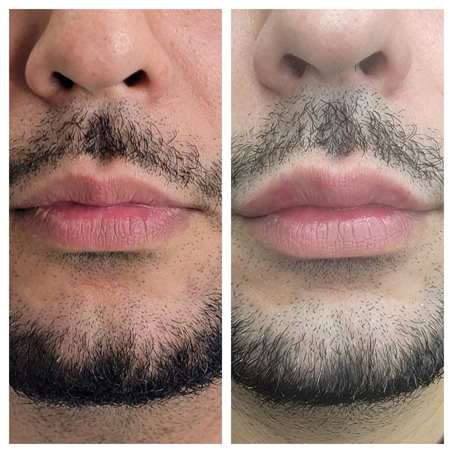 Lip fillers. BEFORE AND AFTER