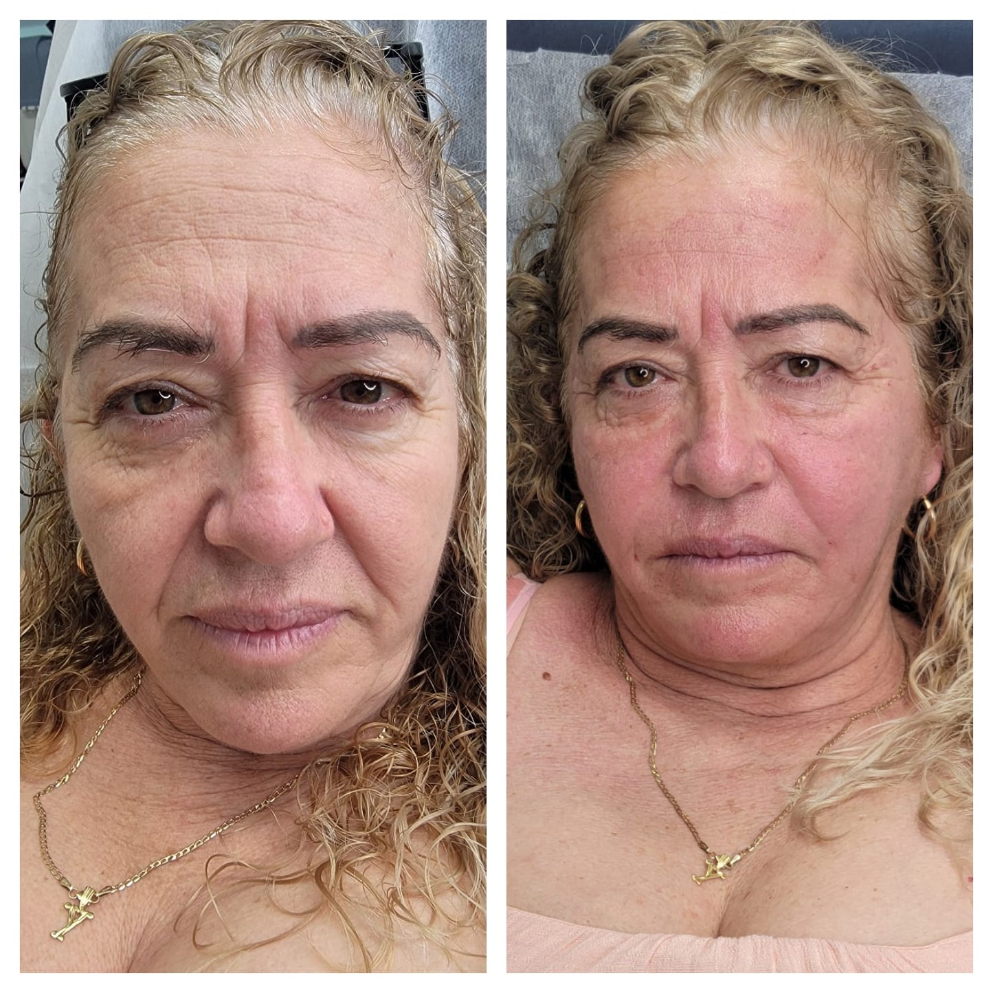 Cosmetic Botox.   BEFORE AND AFTER