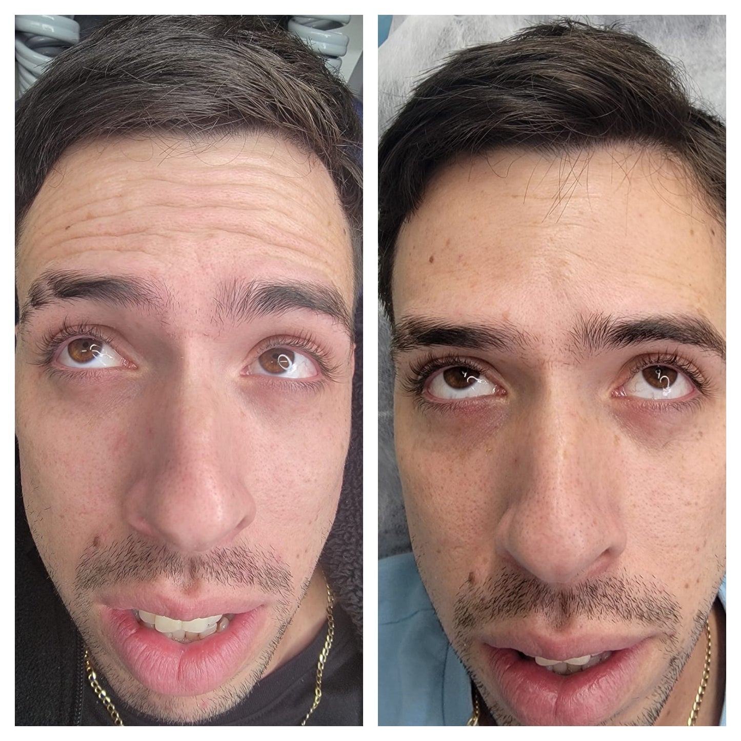 Cosmetic Botox.   BEFORE AND AFTER