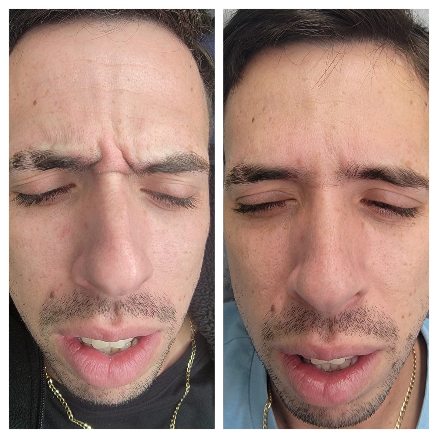 Cosmetic Botox.   BEFORE AND AFTER