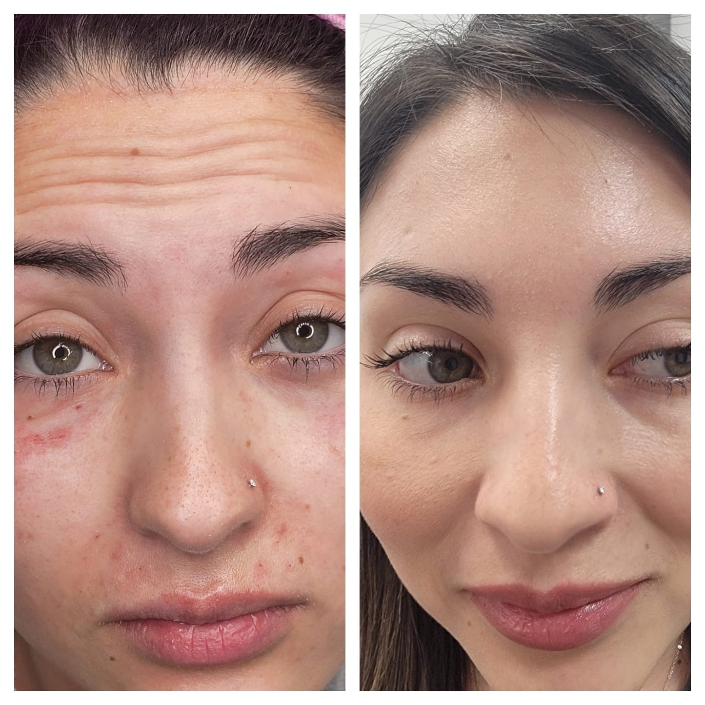 Cosmetic Botox.   BEFORE AND AFTER