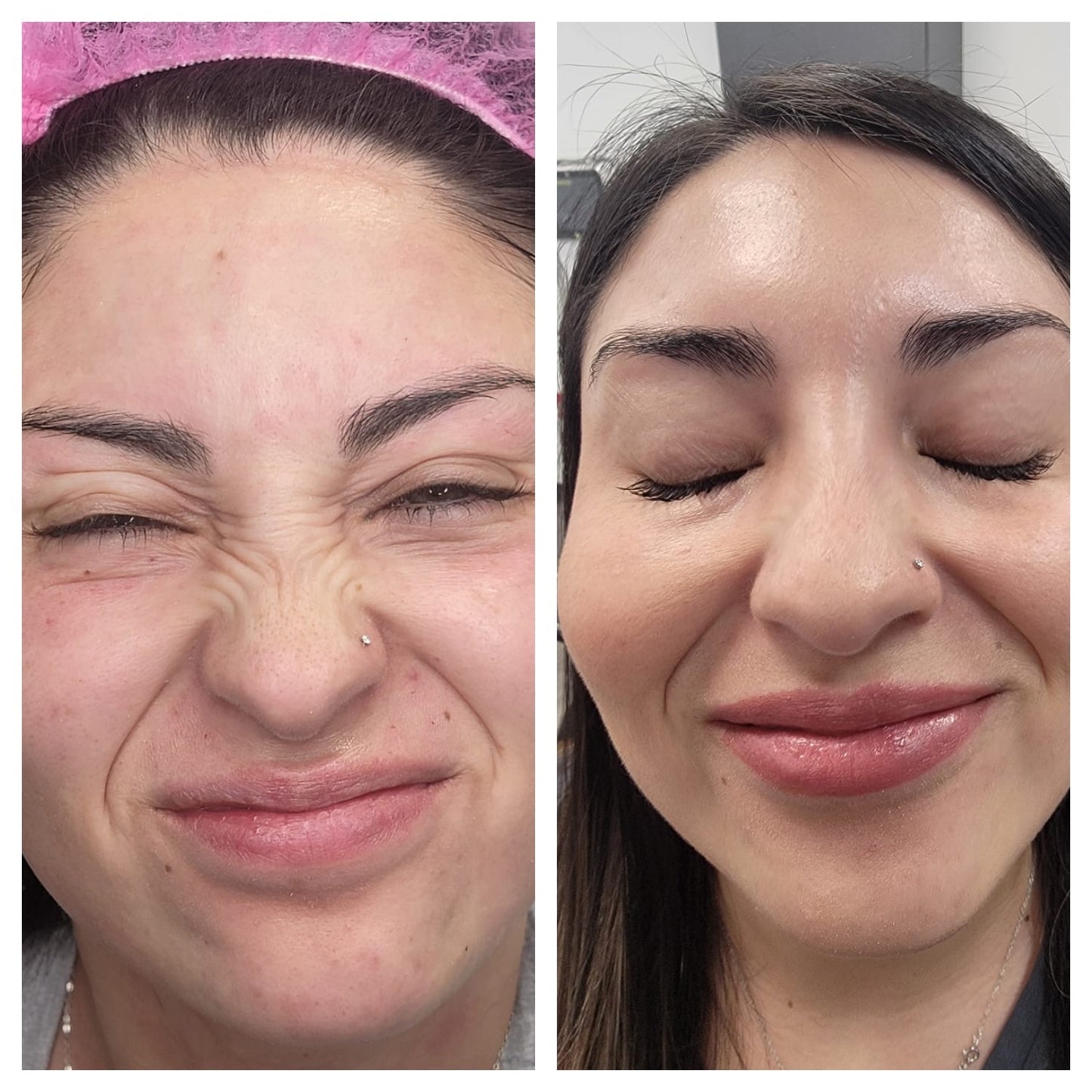 Cosmetic Botox.   BEFORE AND AFTER