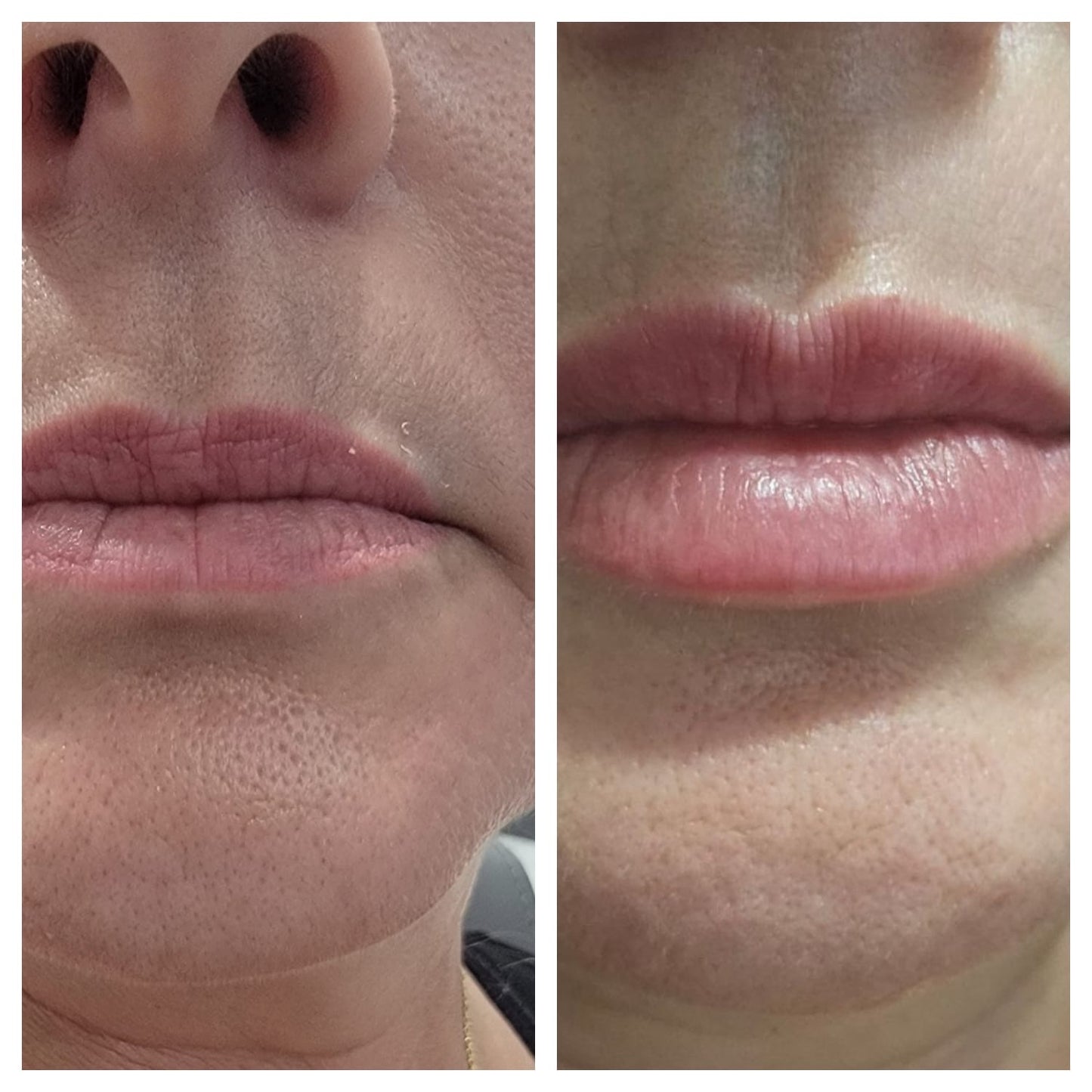 Lip fillers. BEFORE AND AFTER