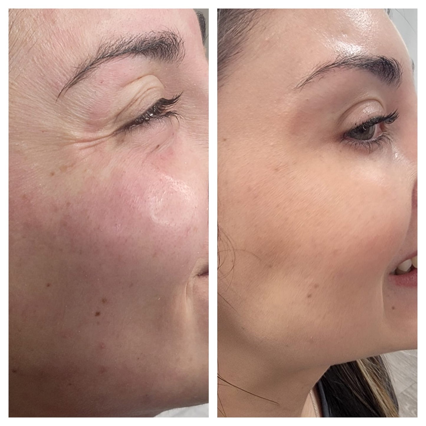 Cosmetic Botox.   BEFORE AND AFTER