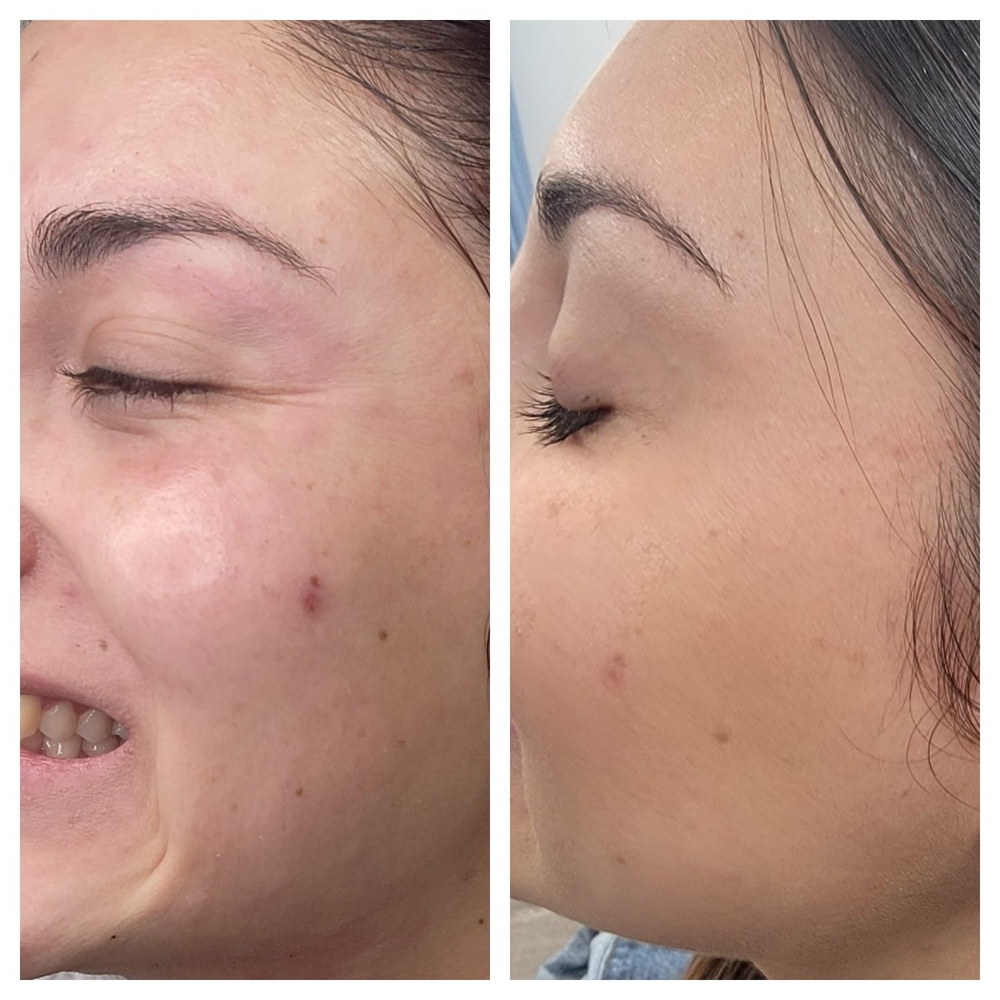 Cosmetic Botox.   BEFORE AND AFTER